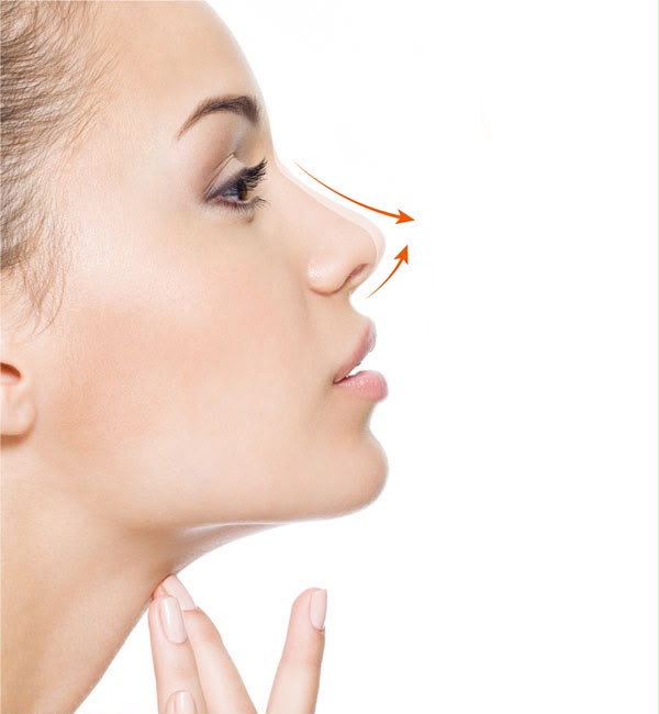 Tip rhinoplasty refining the nasal tip at EsteCenter Istanbul