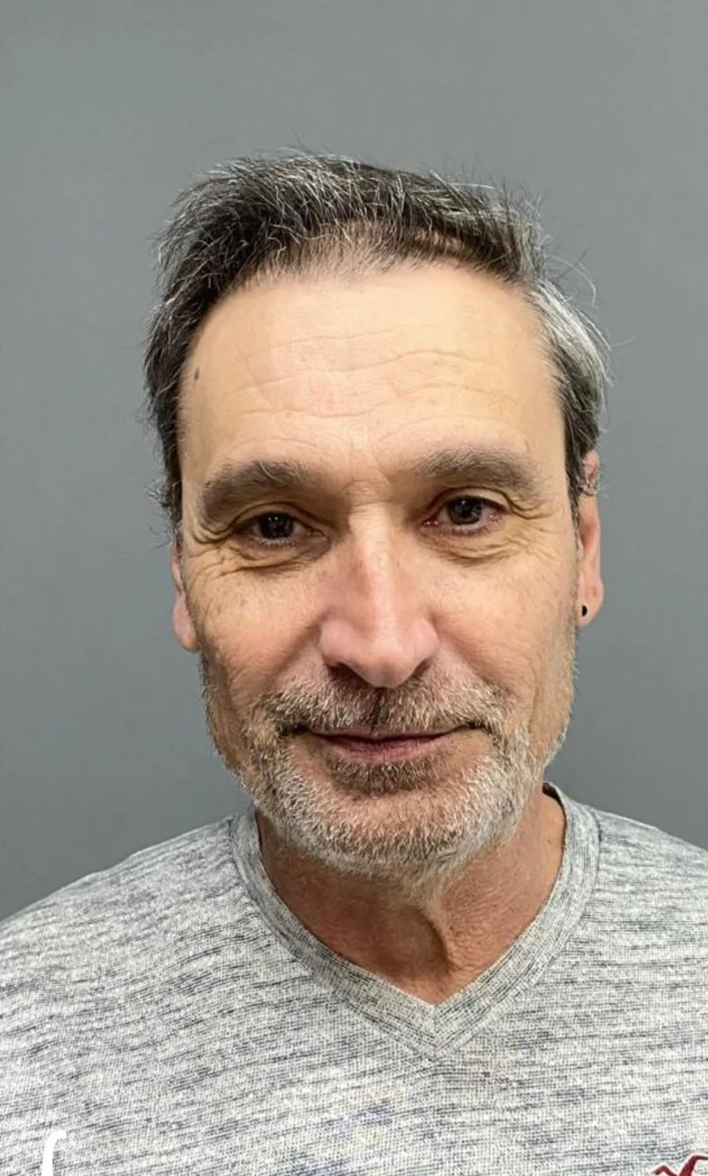 After hair transplant result