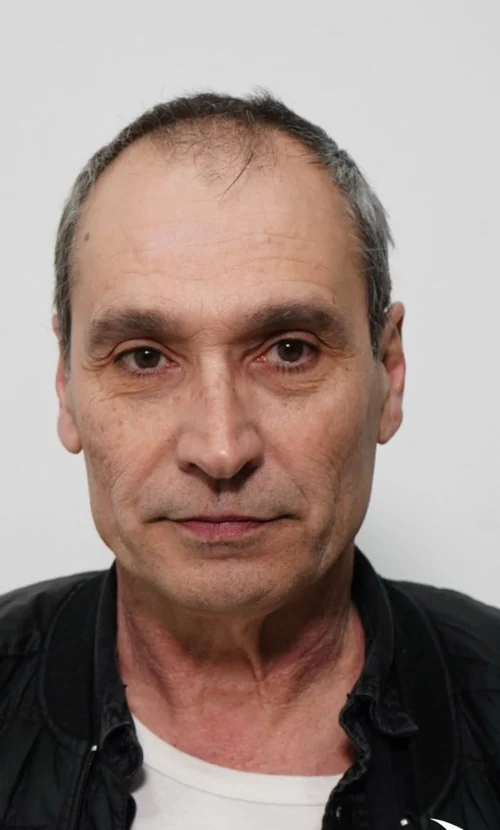 Before hair transplant