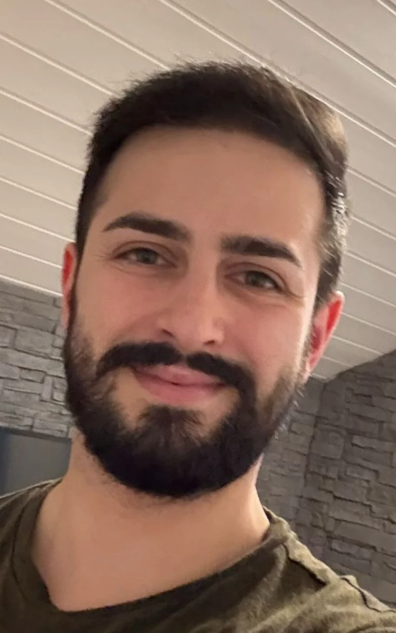 After hair transplant result
