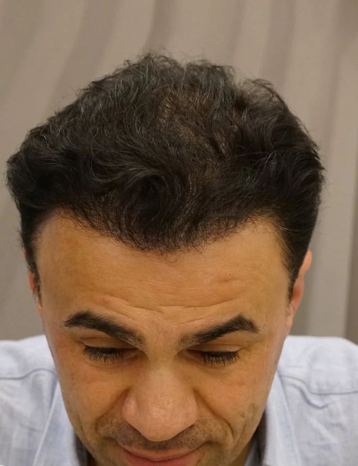 After hair transplant result