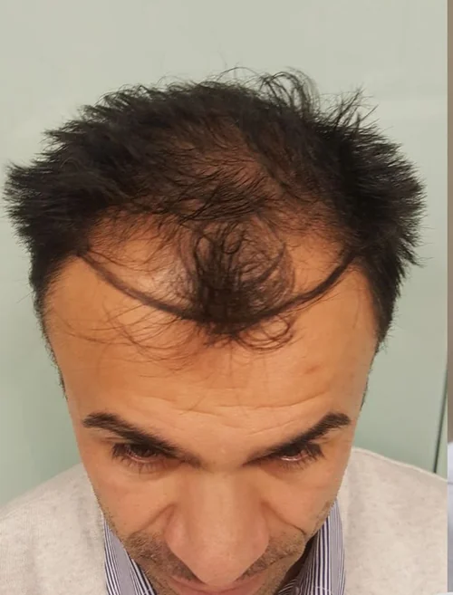 Before hair transplant