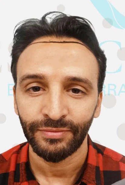 Before hair transplant
