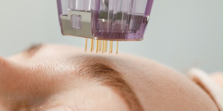 Golden needle Scarlet X radiofrequency microneedling at EsteCenter Istanbul