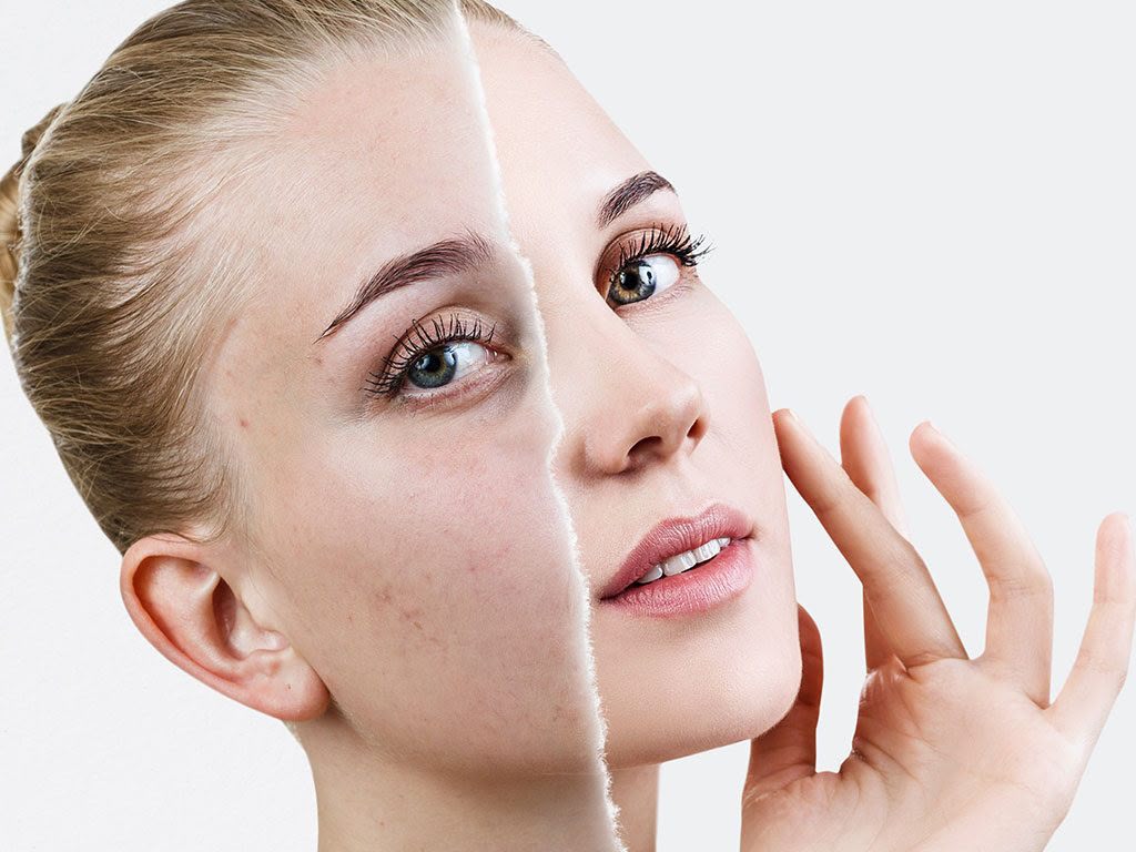 Pigmentation treatment at EsteCenter Istanbul