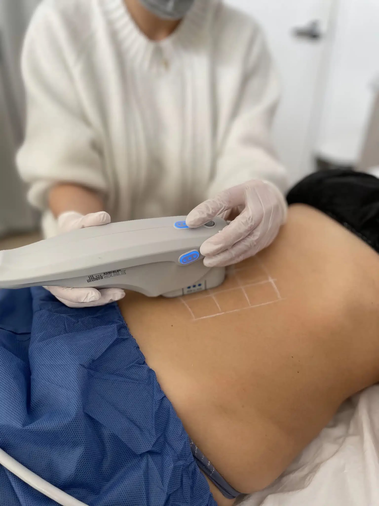 Stretch mark treatment at EsteCenter Istanbul